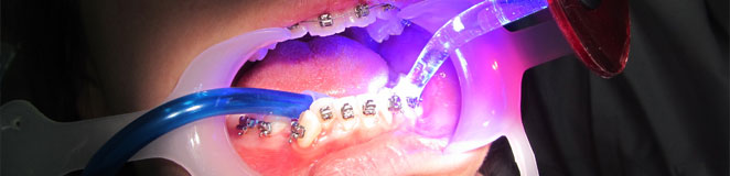 appareil dentaire pas cher appareil dentaire orthodontie appareil dentaire pas cher appareil dentaire orthodontie