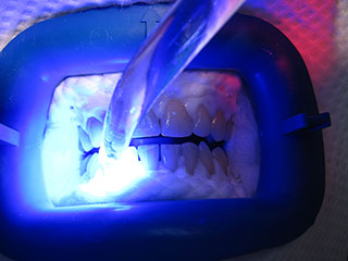 Blanchiment des dents lampe laser