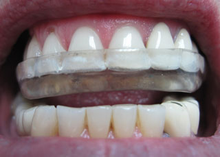 Traitement Bruxisme dentaire en Espagne. Grincement des dents