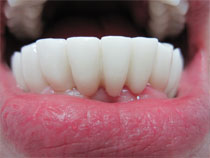Bridge zirconium après