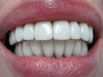 Bridge zirconium après