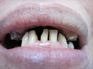Bridge zirconium Avant