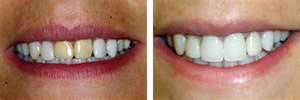Facettes en porcelaine