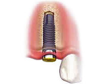 Racine de l'implant dentaire