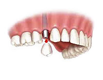 Implant dentaire